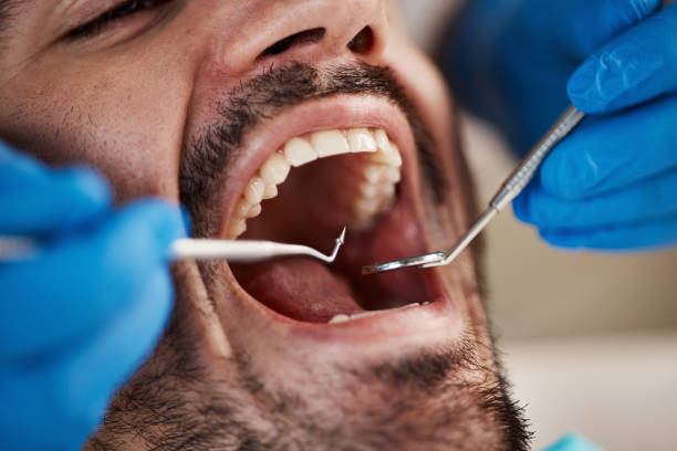 Best Emergency Dental Extractions in Port Labelle, FL